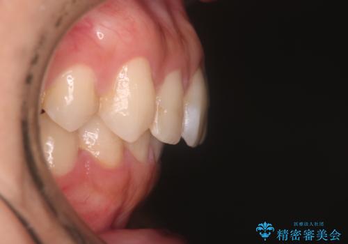 【インビザラインとセラミック】前歯を綺麗にの治療後