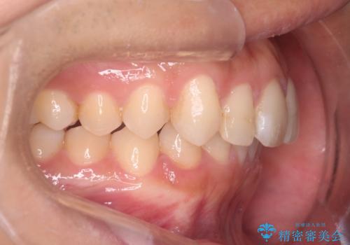 【インビザラインとセラミック】前歯を綺麗にの治療後