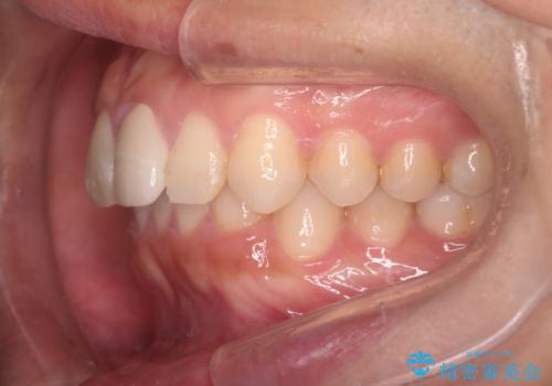 【インビザラインとセラミック】前歯を綺麗にの治療後