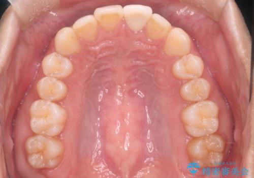 【インビザラインとセラミック】前歯を綺麗にの治療後
