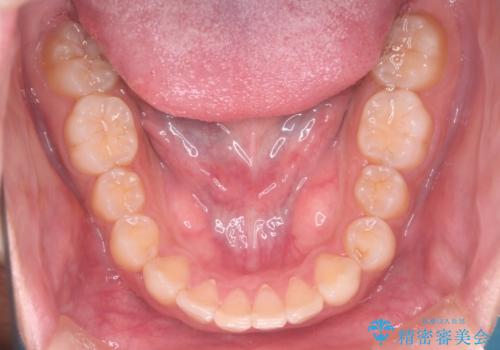 【インビザラインとセラミック】前歯を綺麗にの治療後