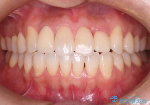 前歯の治療前にホワイトニングで歯を白くの治療前