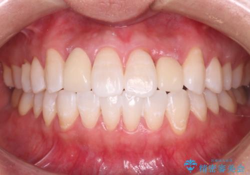 前歯の治療前にホワイトニングで歯を白く