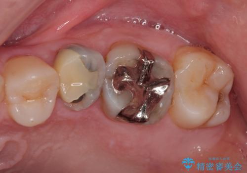 「やり替えるなら良いものを」精度重視の補綴治療を選択された症例の治療前