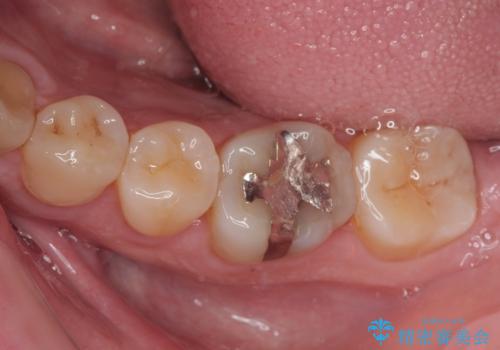 「やり替えるなら良いものを」精度重視の補綴治療を選択された症例の治療前