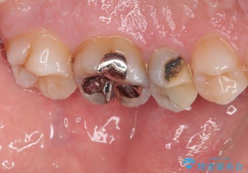 「やり替えるなら良いものを」精度重視の補綴治療を選択された症例の治療前