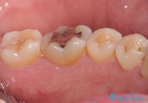 「やり替えるなら良いものを」精度重視の補綴治療を選択された症例の治療前