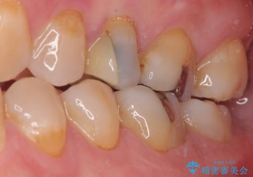 「やり替えるなら良いものを」精度重視の補綴治療を選択された症例の治療前