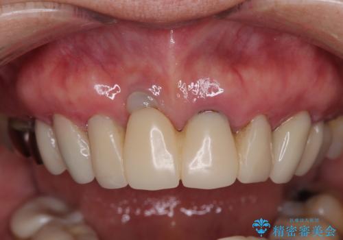 【海外から通院】統一感のない前歯をきれいに オールセラミッククラウン治療の治療中