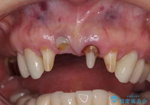 【海外から通院】統一感のない前歯をきれいに オールセラミッククラウン治療の治療前