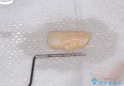 【海外から通院】統一感のない前歯をきれいに　オールセラミッククラウン治療の治療中