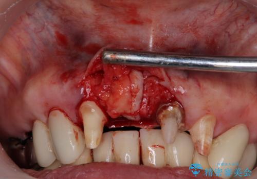 【海外から通院】統一感のない前歯をきれいに オールセラミッククラウン治療の治療中