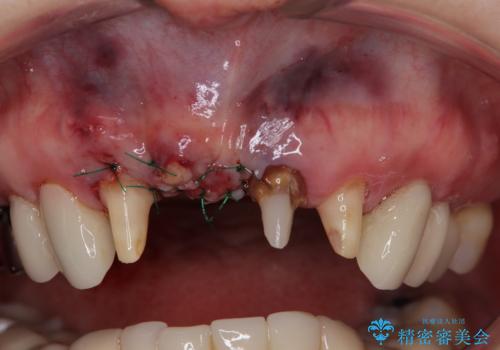 【海外から通院】統一感のない前歯をきれいに オールセラミッククラウン治療の治療後