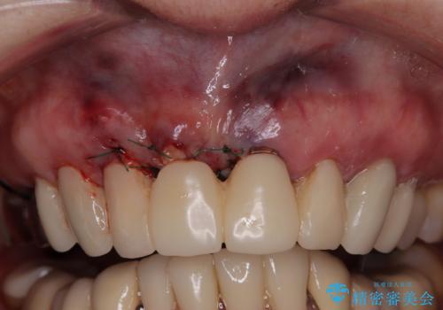 【海外から通院】統一感のない前歯をきれいに オールセラミッククラウン治療の治療後