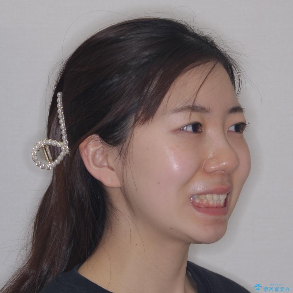 【モニター】デコボコとクロスバイトの前歯 ワイヤー装置での抜歯矯正の治療前(顔貌)