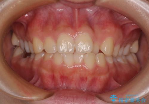 【モニター】デコボコとクロスバイトの前歯　ワイヤー装置での抜歯矯正の治療前