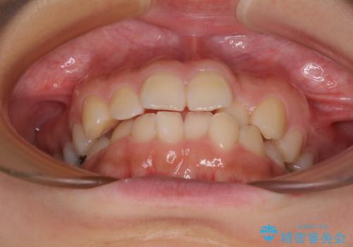 【モニター】デコボコとクロスバイトの前歯　ワイヤー装置での抜歯矯正の治療前