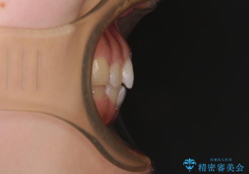 【モニター】デコボコとクロスバイトの前歯　ワイヤー装置での抜歯矯正の治療前