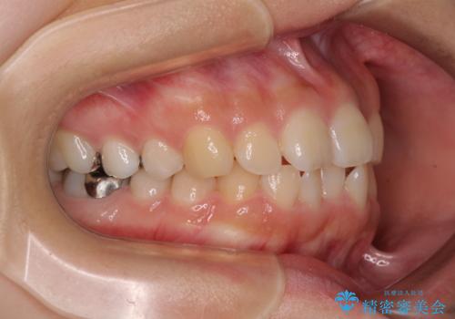 【モニター】デコボコとクロスバイトの前歯 ワイヤー装置での抜歯矯正の治療前