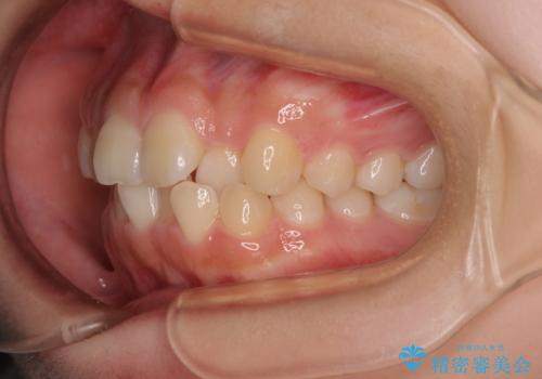 【モニター】デコボコとクロスバイトの前歯　ワイヤー装置での抜歯矯正の治療前