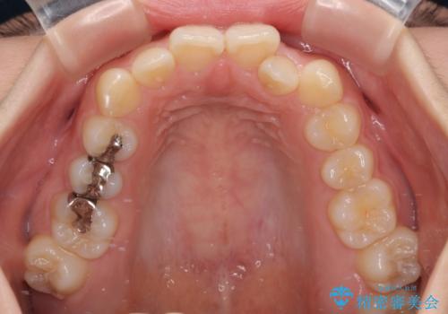 【モニター】デコボコとクロスバイトの前歯　ワイヤー装置での抜歯矯正の治療前