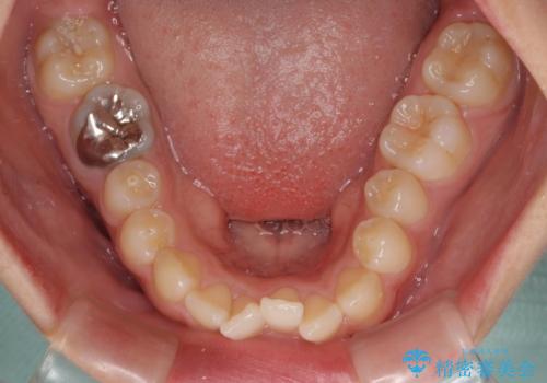 【モニター】デコボコとクロスバイトの前歯　ワイヤー装置での抜歯矯正の治療前