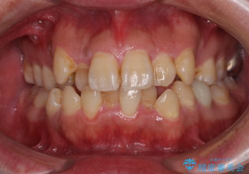 前歯のデコボコを抜歯矯正で改善した症例|目立ちにくい審美装置を使用