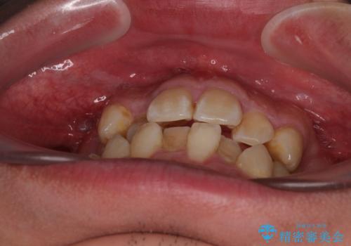 前歯のデコボコを抜歯矯正で改善した症例|目立ちにくい審美装置を使用の治療前