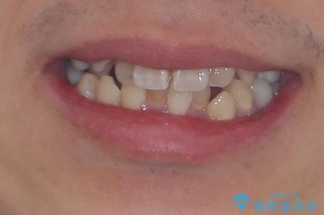 前歯のデコボコを抜歯矯正で改善した症例|目立ちにくい審美装置を使用の治療前(顔貌)