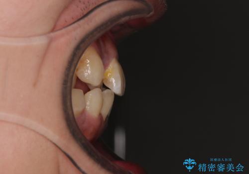 前歯のデコボコを抜歯矯正で改善した症例|目立ちにくい審美装置を使用の治療前