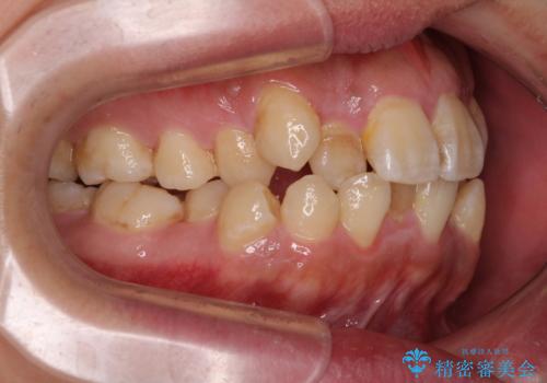 前歯のデコボコを抜歯矯正で改善した症例|目立ちにくい審美装置を使用の治療前