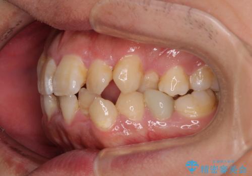 前歯のデコボコを抜歯矯正で改善した症例|目立ちにくい審美装置を使用の治療前