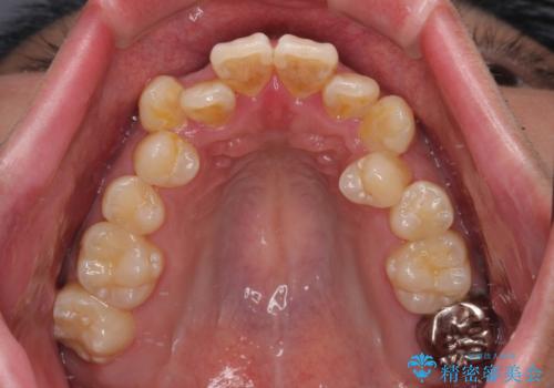 前歯のデコボコを抜歯矯正で改善した症例|目立ちにくい審美装置を使用の治療前