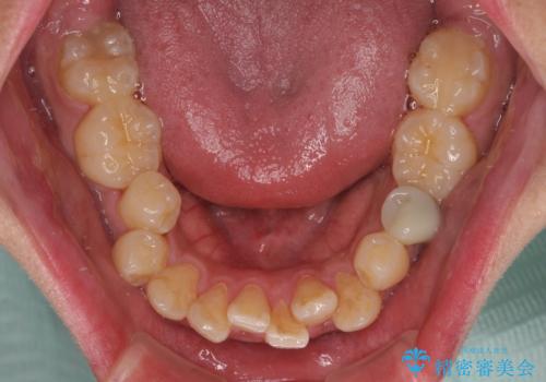 前歯のデコボコを抜歯矯正で改善した症例|目立ちにくい審美装置を使用の治療前