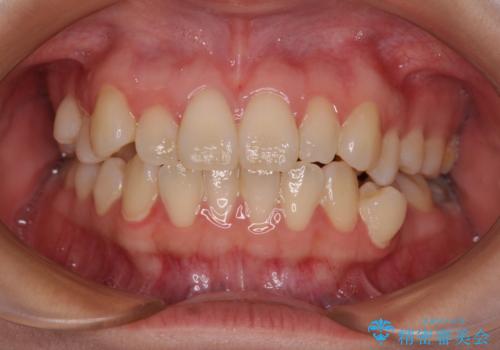 早く・確実に歯並び改善|目立ちにくいワイヤー矯正の治療前