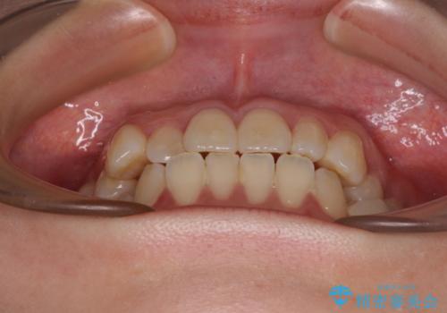 早く・確実に歯並び改善|目立ちにくいワイヤー矯正の治療前