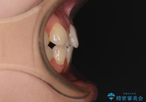 早く・確実に歯並び改善|目立ちにくいワイヤー矯正の治療前