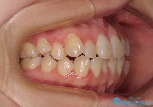 早く・確実に歯並び改善|目立ちにくいワイヤー矯正の治療前