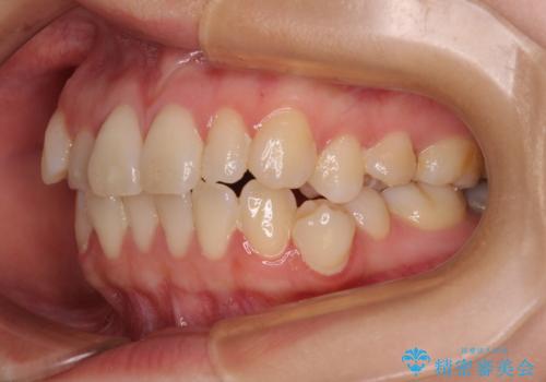 早く・確実に歯並び改善|目立ちにくいワイヤー矯正の治療前