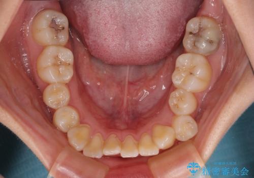 早く・確実に歯並び改善|目立ちにくいワイヤー矯正の治療前