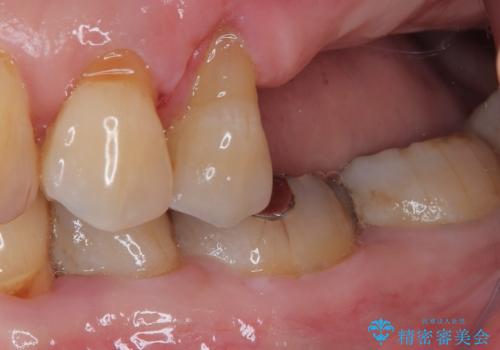 骨量の少ない上顎大臼歯 骨補填材を用いない短期間インプラント治療の治療前