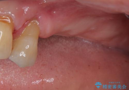 骨量の少ない上顎大臼歯 骨補填材を用いない短期間インプラント治療の治療前