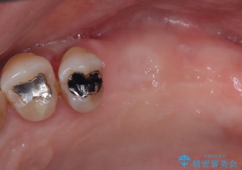 骨量の少ない上顎大臼歯 骨補填材を用いない短期間インプラント治療の治療前
