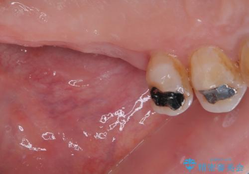 骨量の少ない上顎大臼歯 骨補填材を用いない短期間インプラント治療の治療前