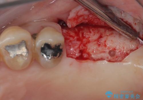 骨量の少ない上顎大臼歯 骨補填材を用いない短期間インプラント治療の治療中