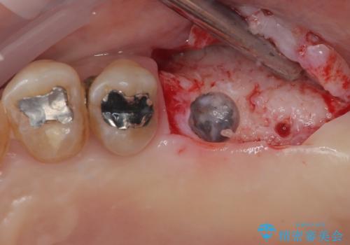 骨量の少ない上顎大臼歯　骨補填材を用いない短期間インプラント治療の治療後