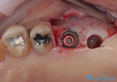 骨量の少ない上顎大臼歯 骨補填材を用いない短期間インプラント治療の治療前