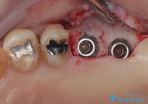 骨量の少ない上顎大臼歯 骨補填材を用いない短期間インプラント治療の治療中