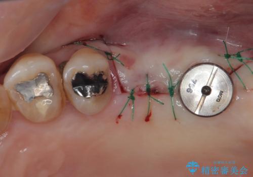 骨量の少ない上顎大臼歯 骨補填材を用いない短期間インプラント治療の治療後