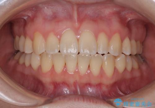 早く・確実に歯並び改善|目立ちにくいワイヤー矯正の治療後